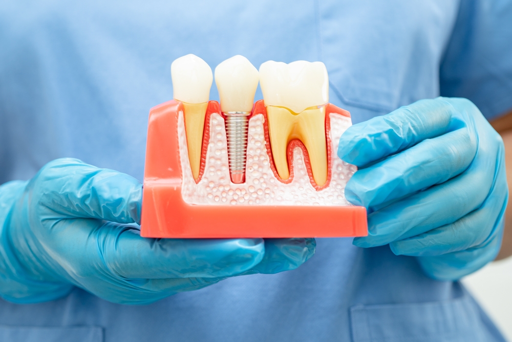 types of dental implants